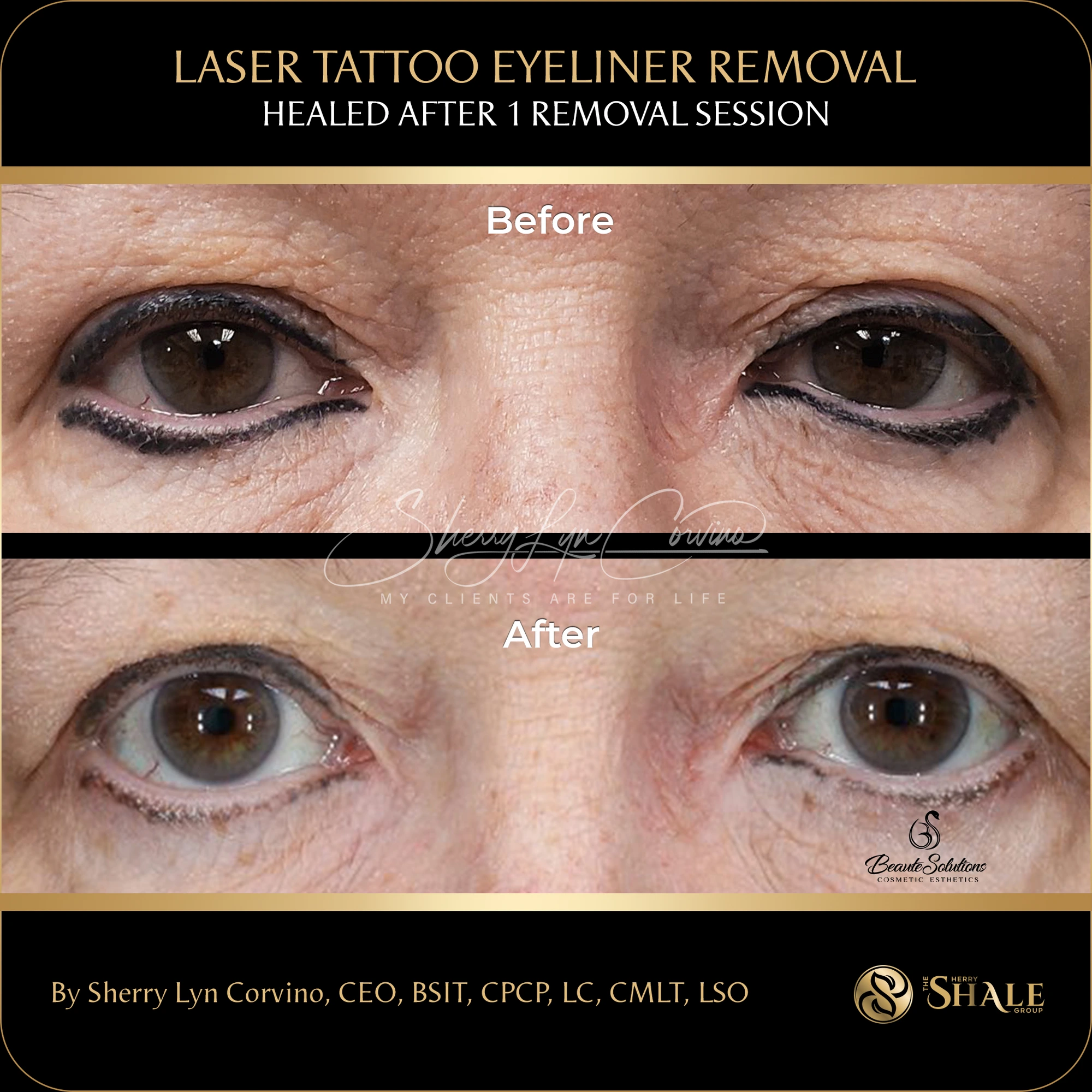 Before and after of eyeliner tattoo removal, healed after one session