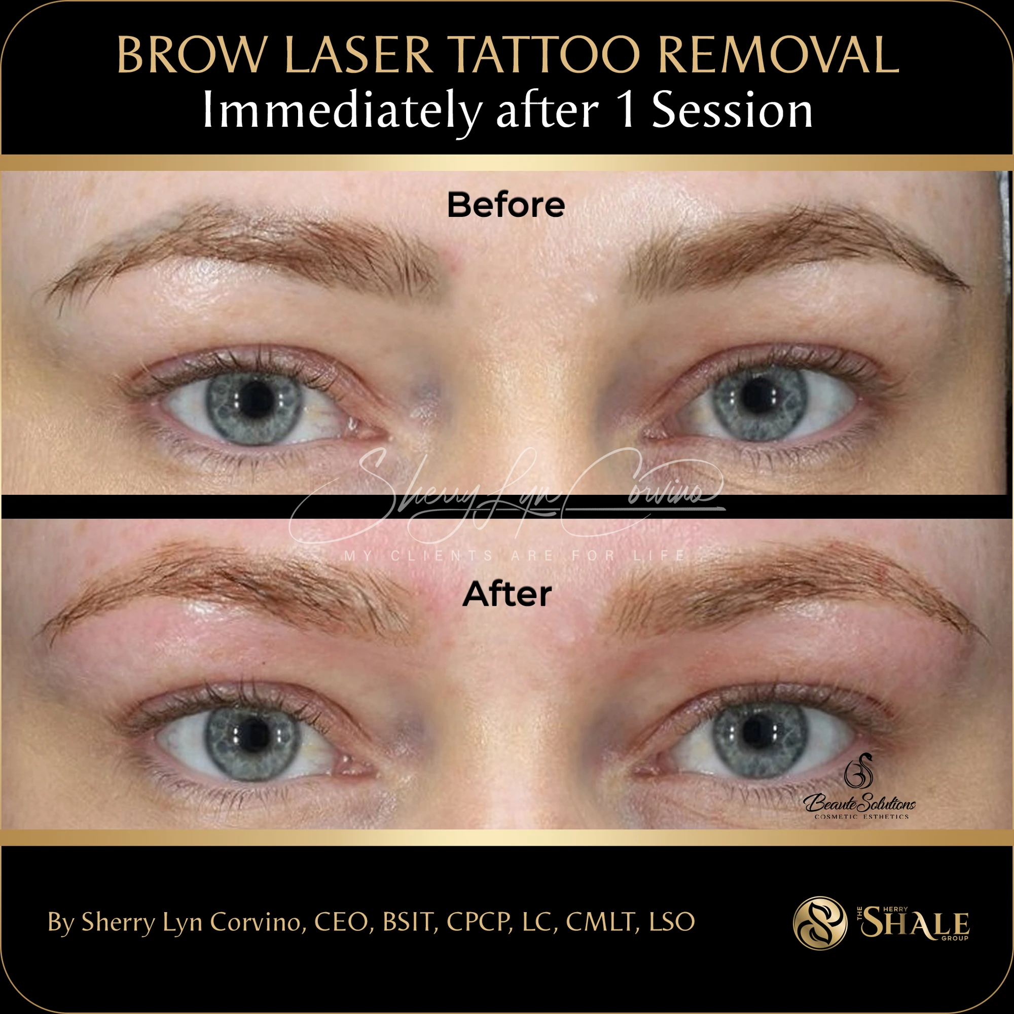 Before and after of brow laser tattoo removal immediately after one session
