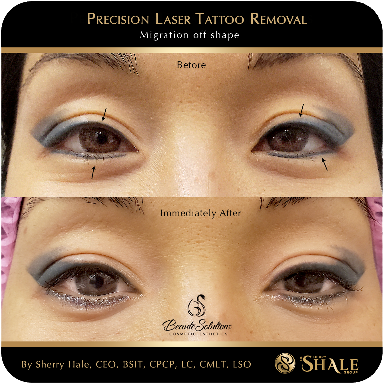 Grey migrated eyeliner tattoo before and immediately after precision laser removal
