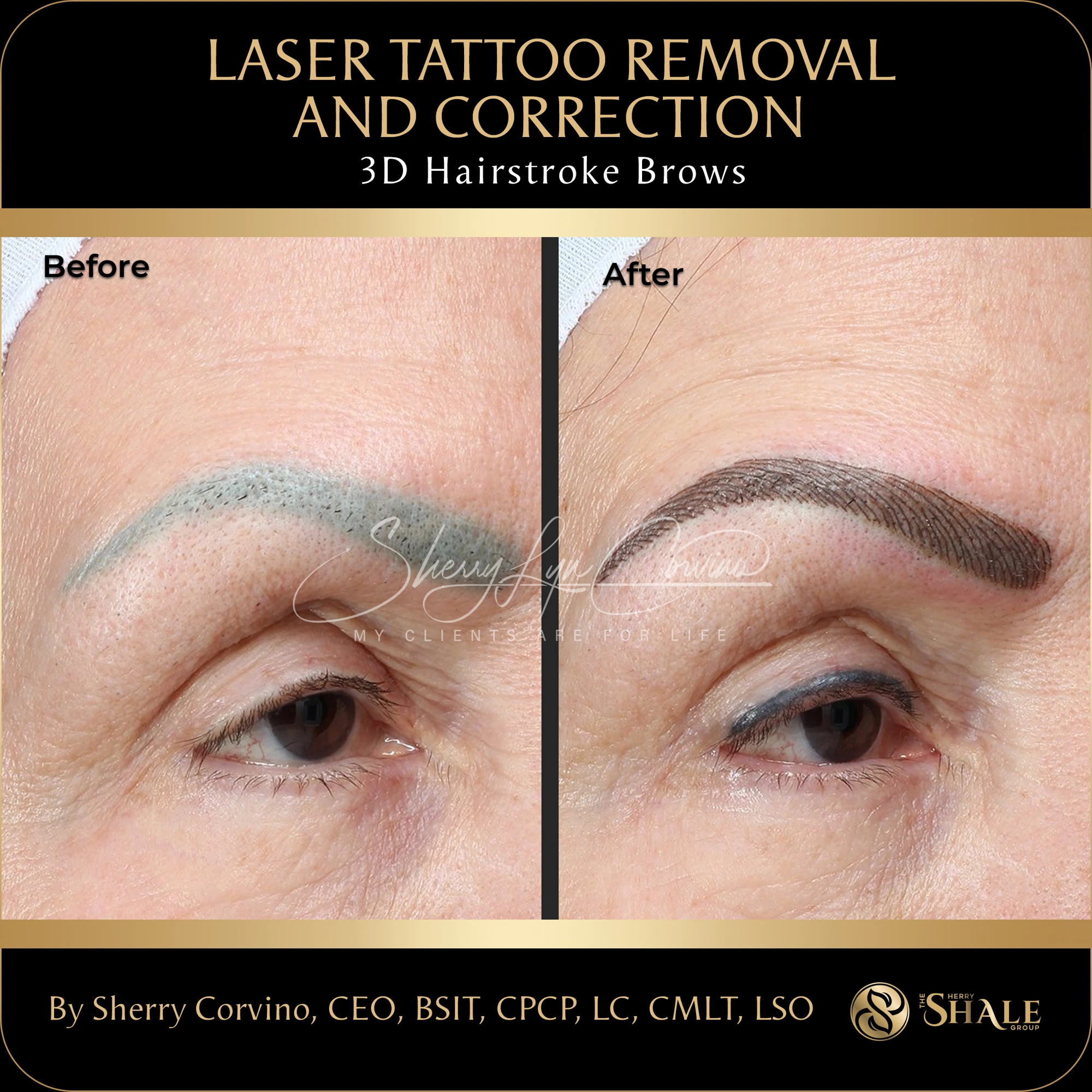Grey eyebrow tattoo removed and corrected with 3D hairstroke brows