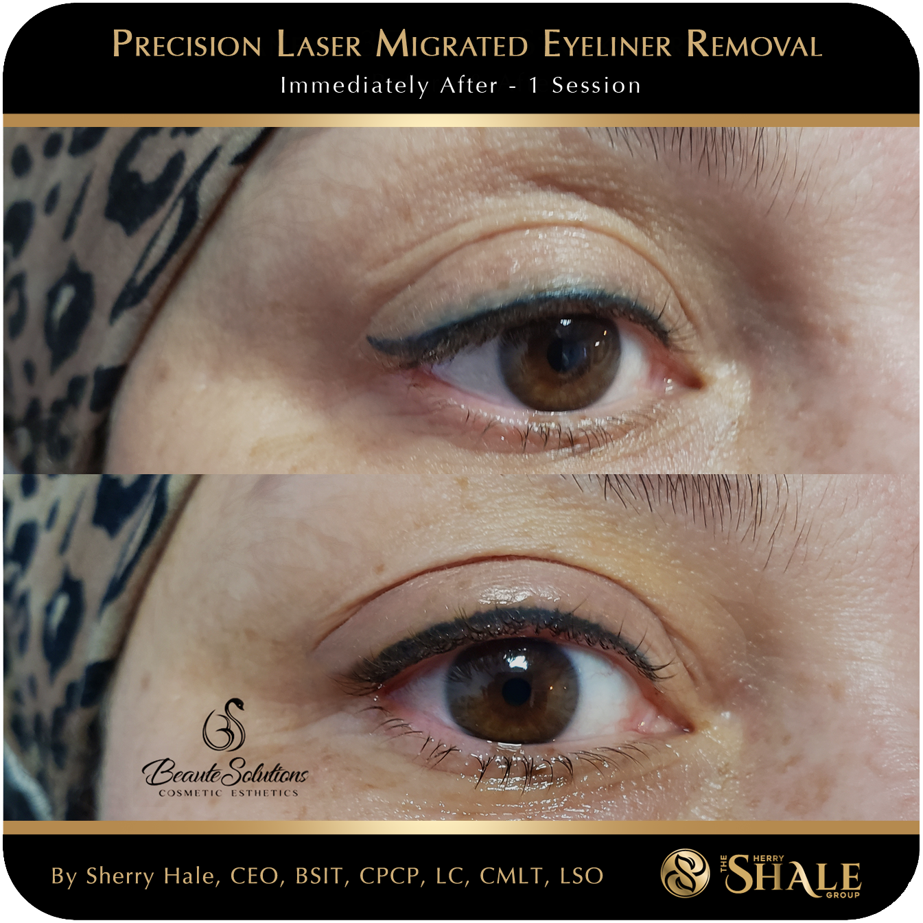 Migrated eyeliner tattoo immediately after one precision laser session