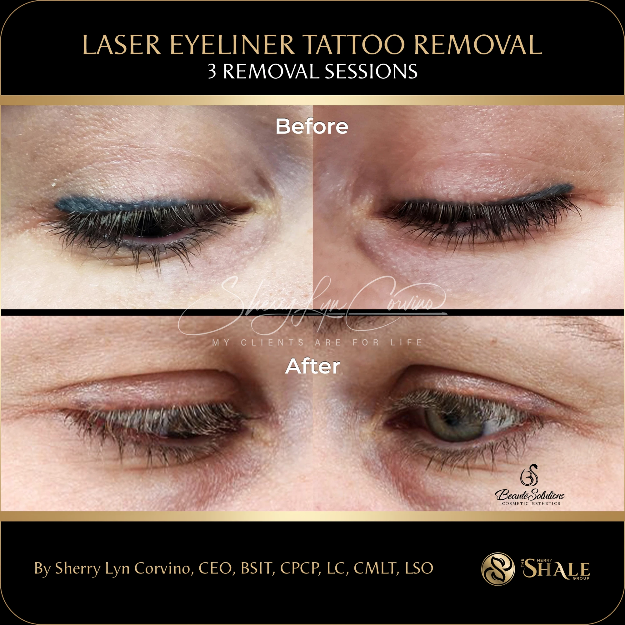 Before and after of laser eyeliner tattoo removal after three sessions