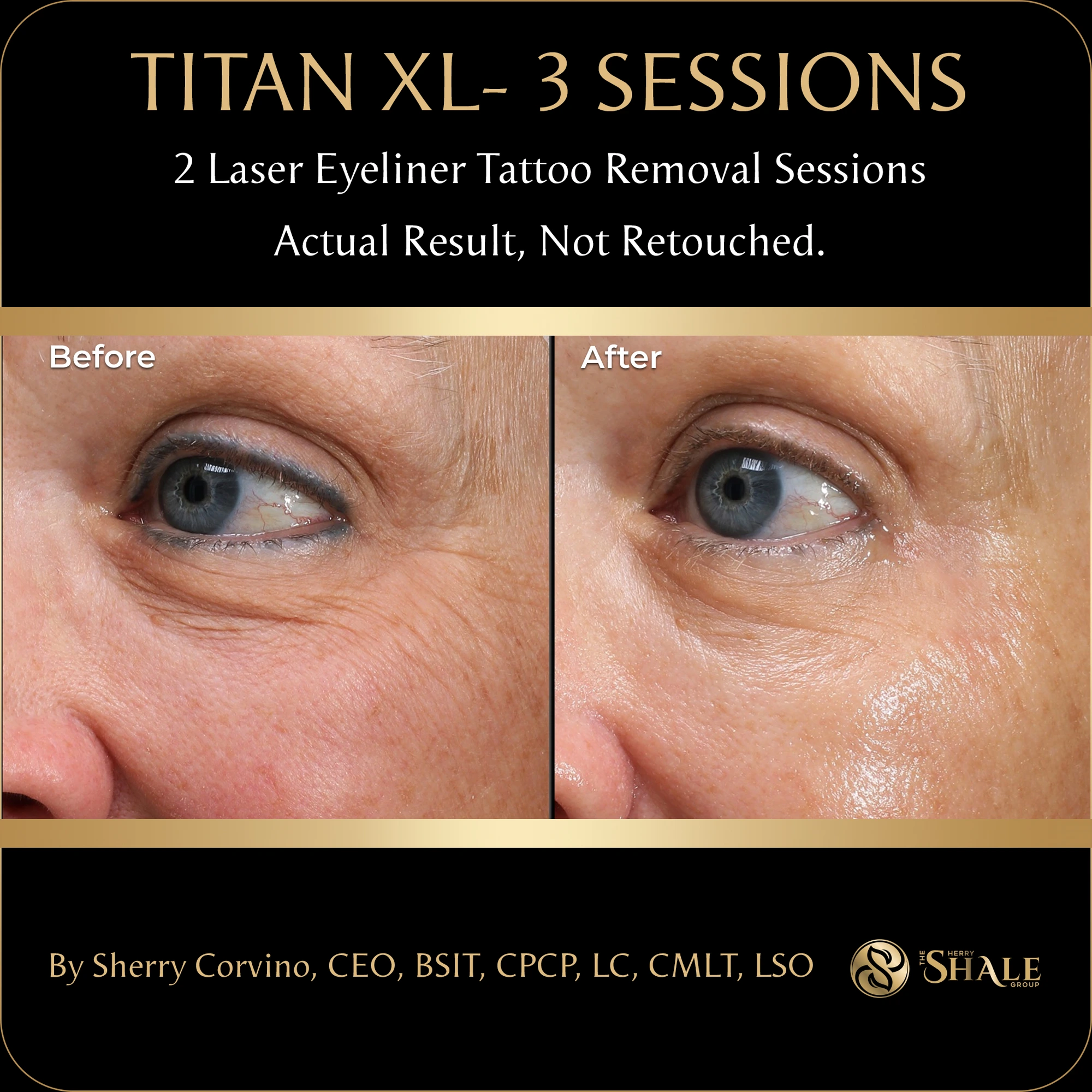 Titan XL laser eyeliner tattoo removal after two sessions, actual result not retouched