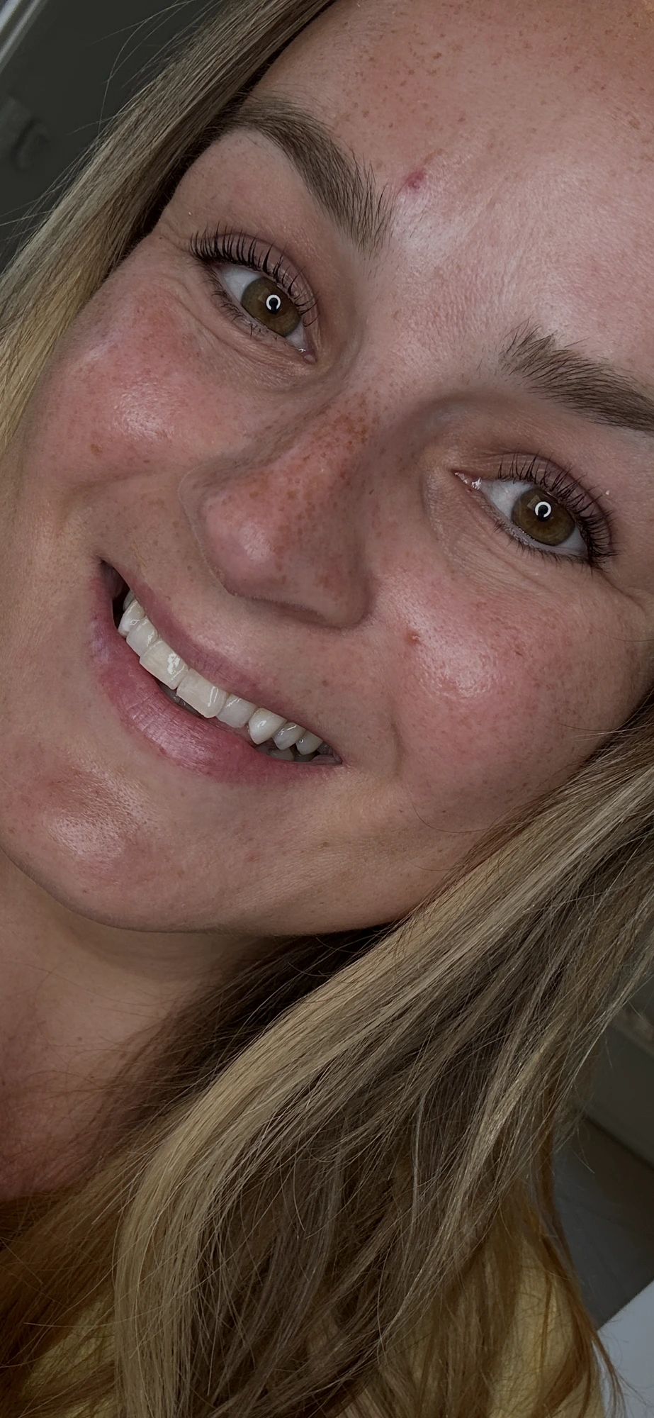 Naturlig lysere smil etter behandling