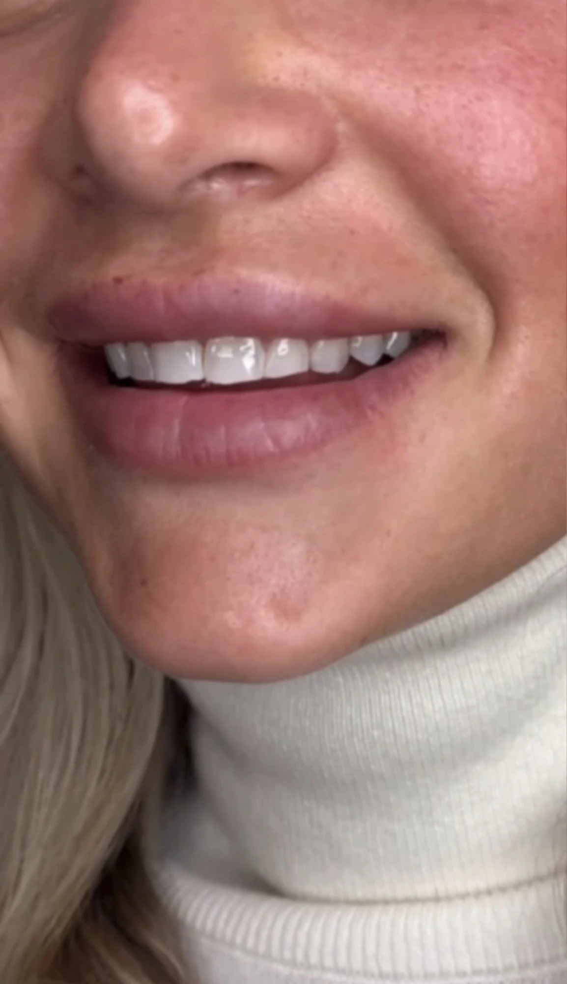 Resultat etter tannbleking – naturlig lysere smil